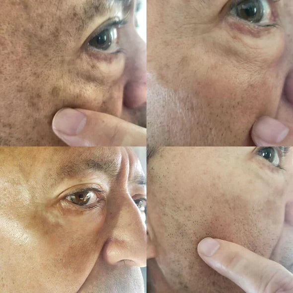 ✨Fast Dark Spot Remover-Natravor®  Melanin Correcting Facial Serum(🔥Last Day Promotion 60% OFF)