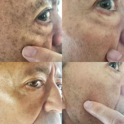 ✨Fast Dark Spot Remover-Natravor®  Melanin Correcting Facial Serum(🔥Last Day Promotion 60% OFF)