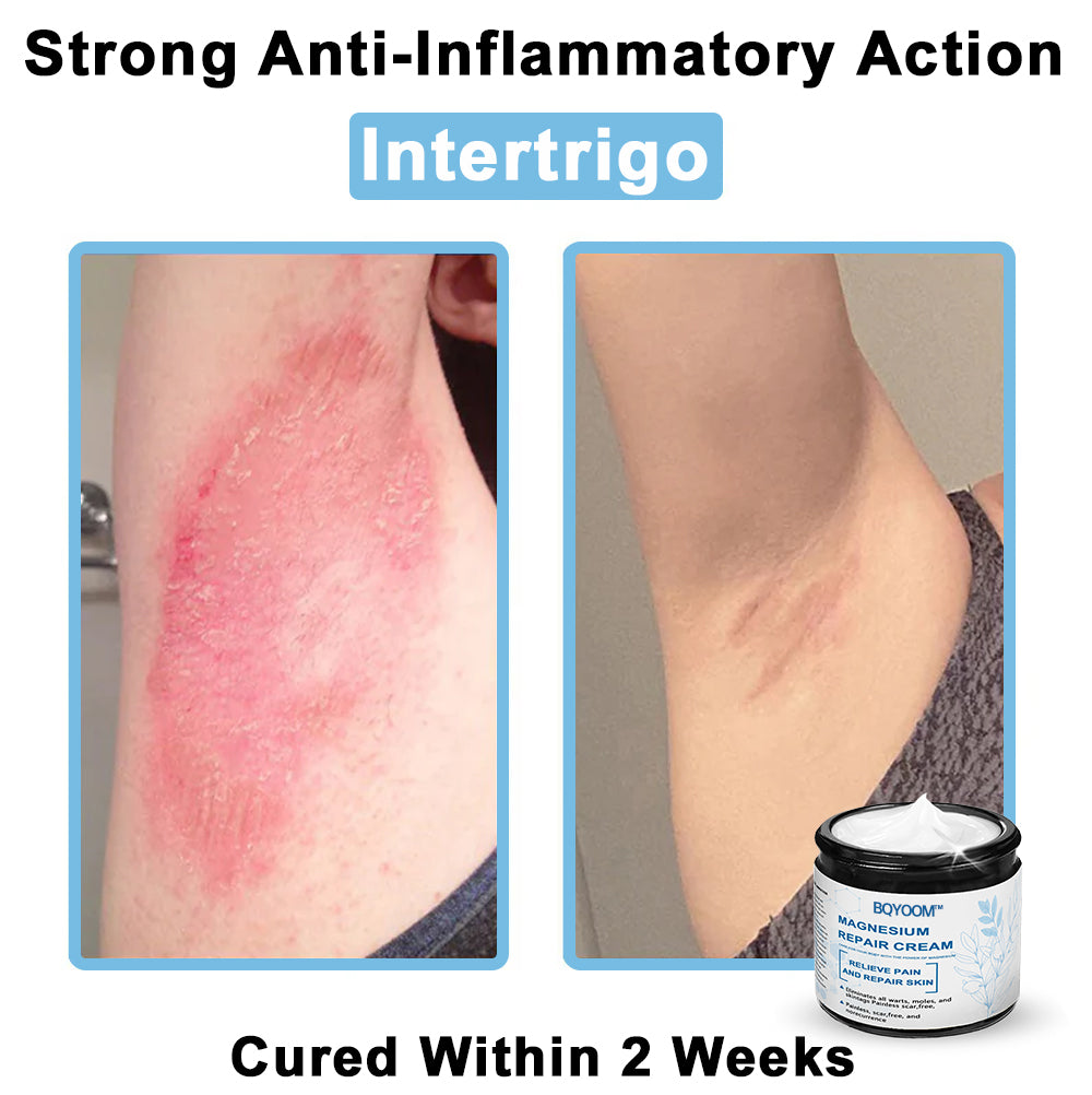 BQYOOMTM Magnesium skin repair cream👨‍⚕️NHS Approved (Psoriasis and Eczema Relief, Skin Repair, Even Tone, Acne and Dark Spot Treatment, Wart and Mole Removal)