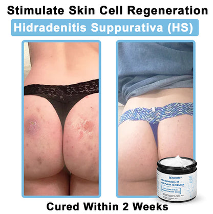 BQYOOMTM Magnesium skin repair cream👨‍⚕️NHS Approved (Psoriasis and Eczema Relief, Skin Repair, Even Tone, Acne and Dark Spot Treatment, Wart and Mole Removal)