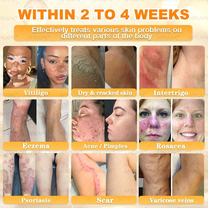 Made and Shipped from USA ✨✨𝖠𝖯𝖪𝖠𝖯𝖪® 𝖡𝖾𝖾 𝗏𝖾𝗇𝗈𝗆 𝖲𝗄𝗂𝗇 𝖱𝖾𝗌𝗍𝗈𝗋𝖺𝗍𝗂𝗈𝗇 𝖢𝗋𝖾𝖺𝗆