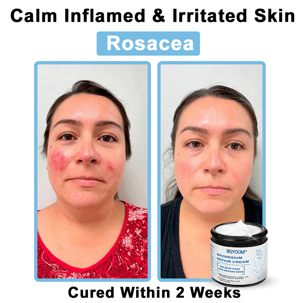 BQYOOMTM Magnesium skin repair cream👨‍⚕️NHS Approved (Psoriasis and Eczema Relief, Skin Repair, Even Tone, Acne and Dark Spot Treatment, Wart and Mole Removal)
