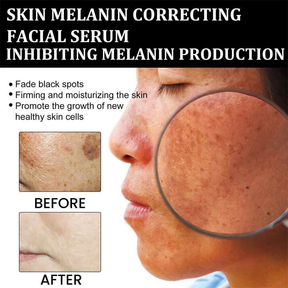✨Fast Dark Spot Remover-Natravor®  Melanin Correcting Facial Serum(🔥Last Day Promotion 60% OFF)