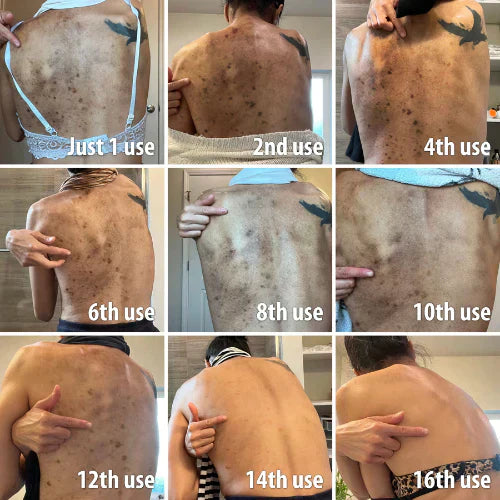 ✨Fast Dark Spot Remover-Natravor®  Melanin Correcting Facial Serum(🔥Last Day Promotion 60% OFF)