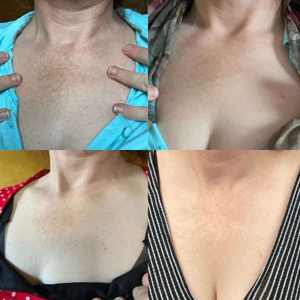 ✨Fast Dark Spot Remover-Natravor®  Melanin Correcting Facial Serum(🔥Last Day Promotion 60% OFF)