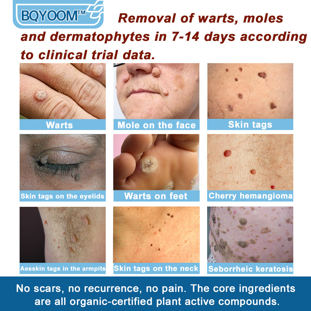 BQYOOMTM Magnesium skin repair cream👨‍⚕️NHS Approved (Psoriasis and Eczema Relief, Skin Repair, Even Tone, Acne and Dark Spot Treatment, Wart and Mole Removal)