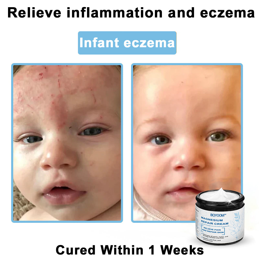 BQYOOMTM Magnesium skin repair cream👨‍⚕️NHS Approved (Psoriasis and Eczema Relief, Skin Repair, Even Tone, Acne and Dark Spot Treatment, Wart and Mole Removal)